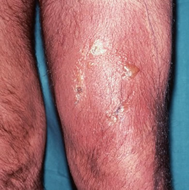 Fig 6: Cellulitis. Reproduced with permission from Wellcome Images.