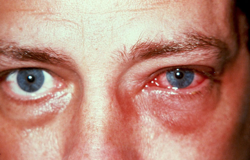 Information about Herpes Eye Disease and Other Herpes ...