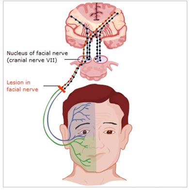 Facial Nerve Weakness 45