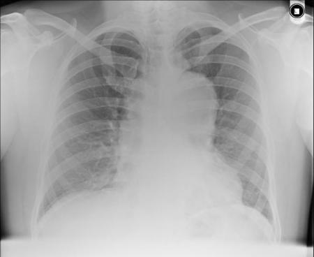 CXR thoracic dissection.preview