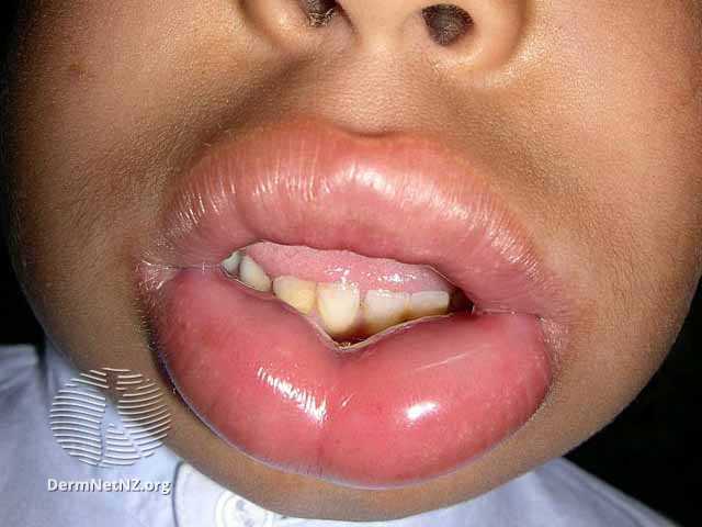 Angioedema of the lips