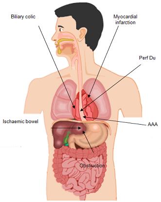 Pancreatitis - organs and digestive system