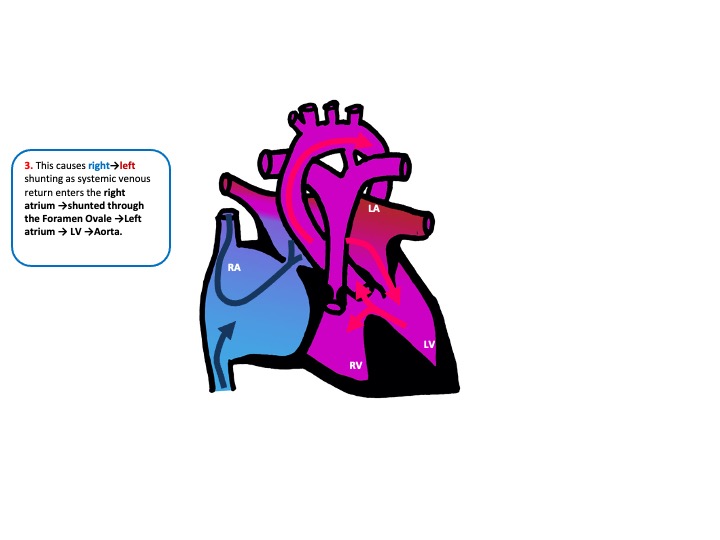 congenital heart